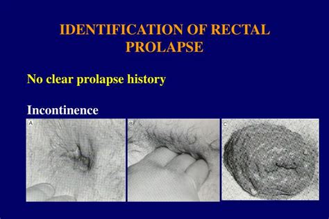 anal gaping prolapse|'anal gape prolapse' Search .